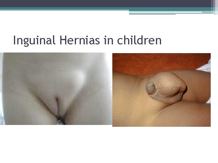 Inguinal Hernias in children Inguinal Hernias in children