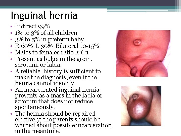 Inguinal hernia • • • Indirect 99% 1% to 3% of all children 3% Inguinal hernia • • • Indirect 99% 1% to 3% of all children 3%