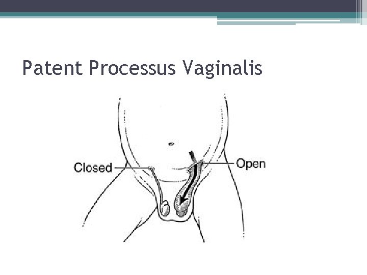 Patent Processus Vaginalis Patent Processus Vaginalis