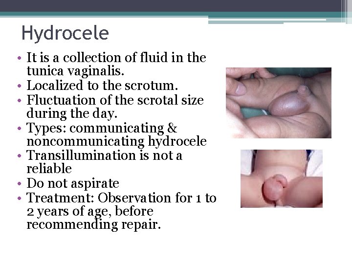 Hydrocele • It is a collection of fluid in the tunica vaginalis. • Localized Hydrocele • It is a collection of fluid in the tunica vaginalis. • Localized