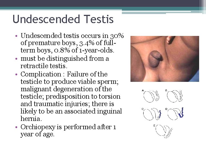 Undescended Testis • Undescended testis occurs in 30% of premature boys, 3. 4% of Undescended Testis • Undescended testis occurs in 30% of premature boys, 3. 4% of