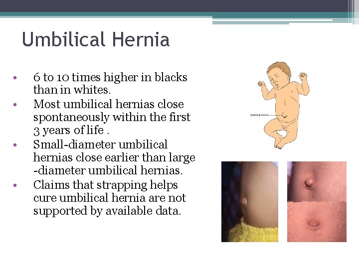 Umbilical Hernia • • 6 to 10 times higher in blacks than in whites. Umbilical Hernia • • 6 to 10 times higher in blacks than in whites.