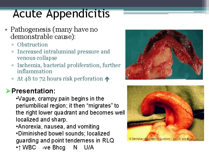 Acute Appendicitis • Pathogenesis (many have no demonstrable cause): ▫ Obstruction ▫ Increased intraluminal Acute Appendicitis • Pathogenesis (many have no demonstrable cause): ▫ Obstruction ▫ Increased intraluminal