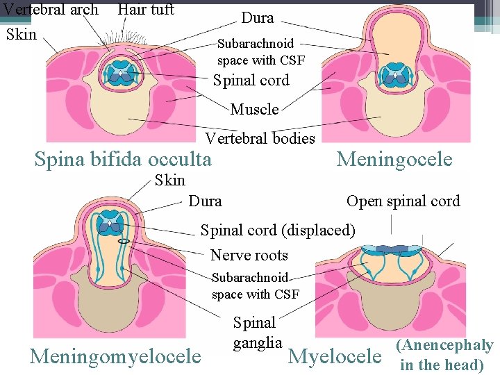 Vertebral arch Skin Hair tuft Dura Subarachnoid space with CSF Spinal cord Muscle Vertebral Vertebral arch Skin Hair tuft Dura Subarachnoid space with CSF Spinal cord Muscle Vertebral
