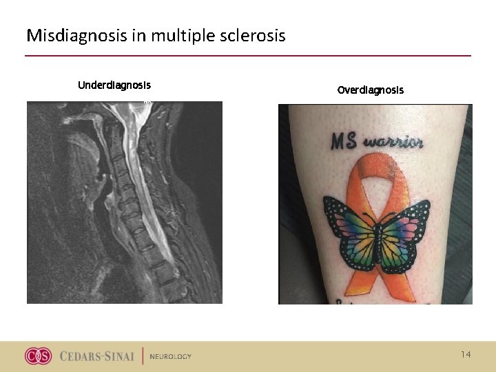 Misdiagnosis in multiple sclerosis Underdiagnosis Overdiagnosis 14 Misdiagnosis in multiple sclerosis Underdiagnosis Overdiagnosis 14