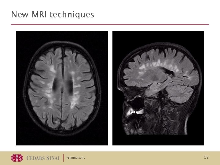 New MRI techniques NEUROLOGY 22 New MRI techniques NEUROLOGY 22