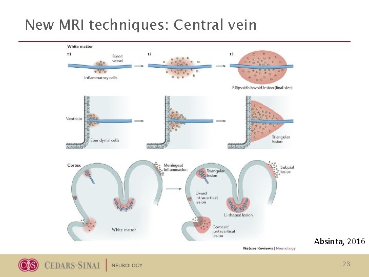 New MRI techniques: Central vein Absinta, 2016 23 New MRI techniques: Central vein Absinta, 2016 23