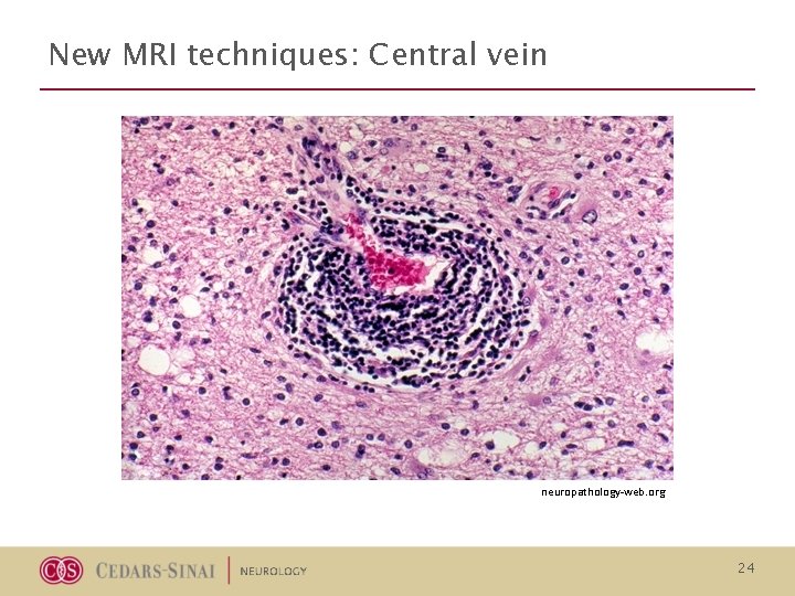 New MRI techniques: Central vein neuropathology-web. org 24 New MRI techniques: Central vein neuropathology-web. org 24