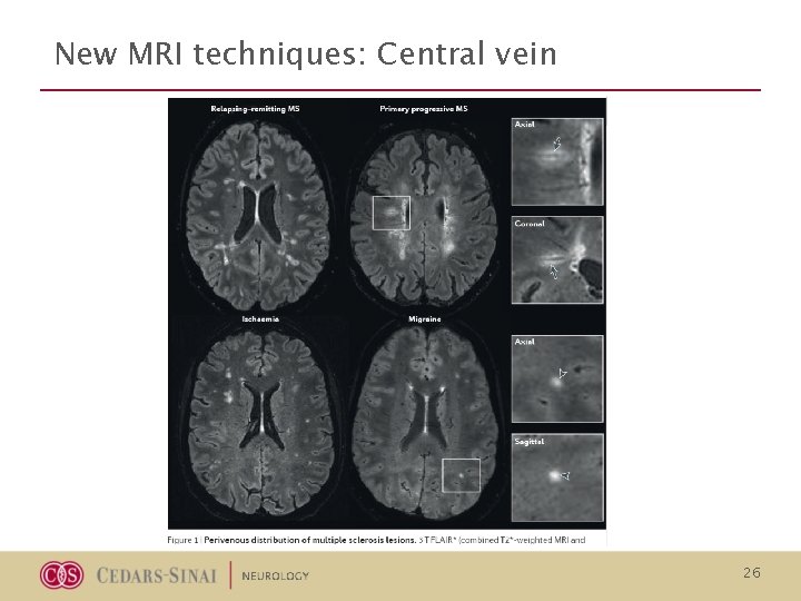 New MRI techniques: Central vein 26 New MRI techniques: Central vein 26