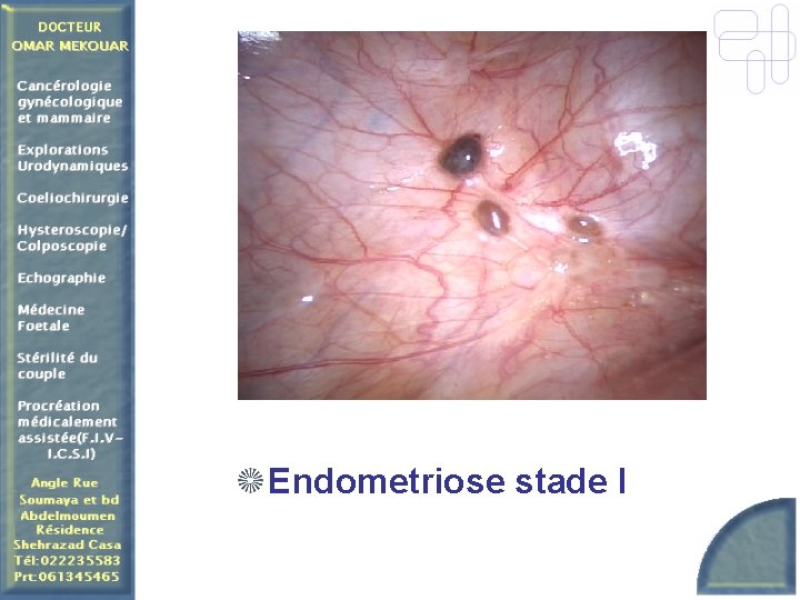 Endometriose stade I 