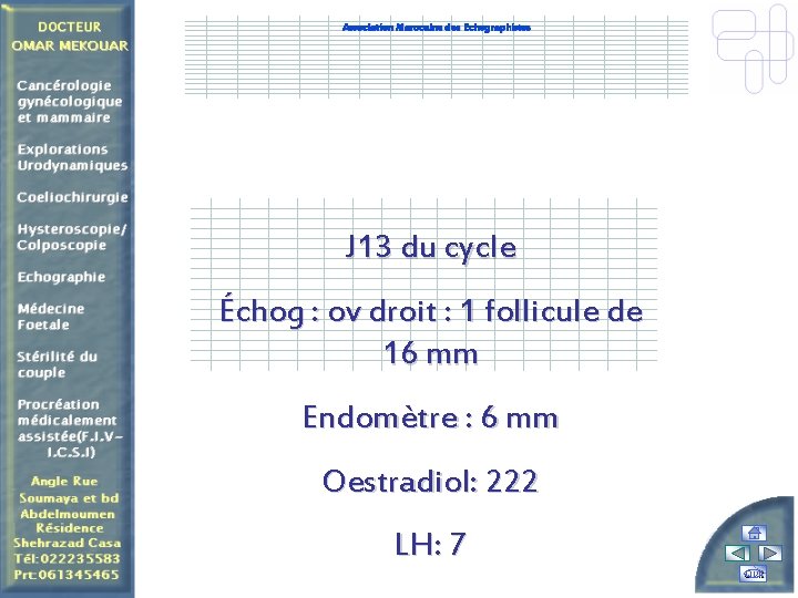 Association Marocaine des Echographistes J 13 du cycle Échog : ov droit : 1