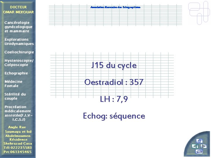 Association Marocaine des Echographistes J 15 du cycle Oestradiol : 357 LH : 7,