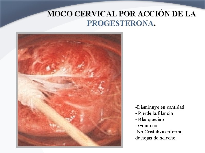 MOCO CERVICAL POR ACCIÓN DE LA PROGESTERONA. -Disminuye en cantidad - Pierde la filancia