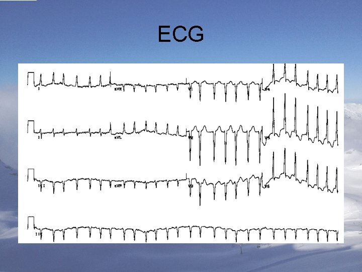 ECG 