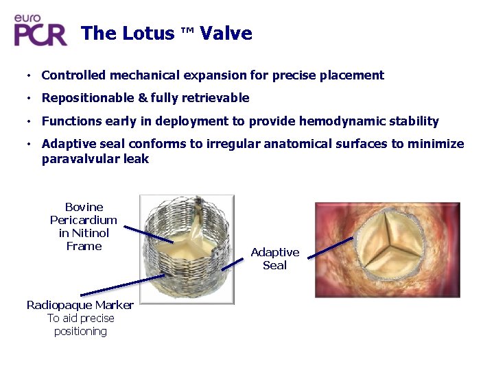 The Lotus ™ Valve • Controlled mechanical expansion for precise placement • Repositionable &