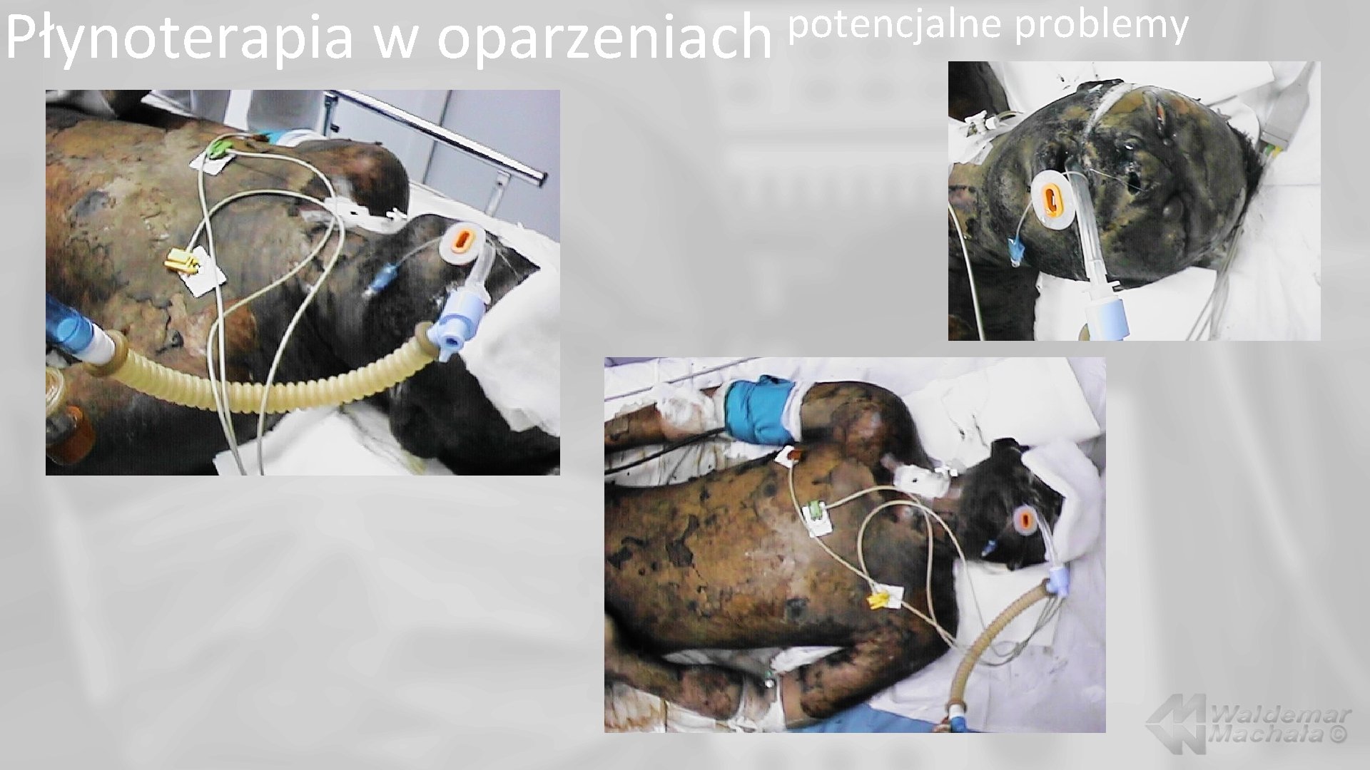 Płynoterapia w potencjalne problemy oparzeniach 
