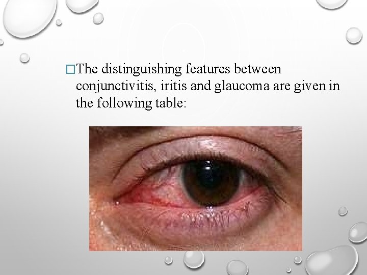 �The distinguishing features between conjunctivitis, iritis and glaucoma are given in the following table: