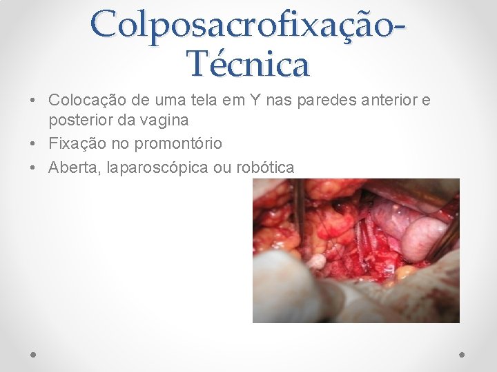 Colposacrofixação. Técnica • Colocação de uma tela em Y nas paredes anterior e posterior Colposacrofixação. Técnica • Colocação de uma tela em Y nas paredes anterior e posterior