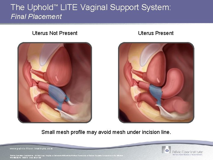The Uphold™ LITE Vaginal Support System: Final Placement Uterus Not Present Uterus Present Small The Uphold™ LITE Vaginal Support System: Final Placement Uterus Not Present Uterus Present Small