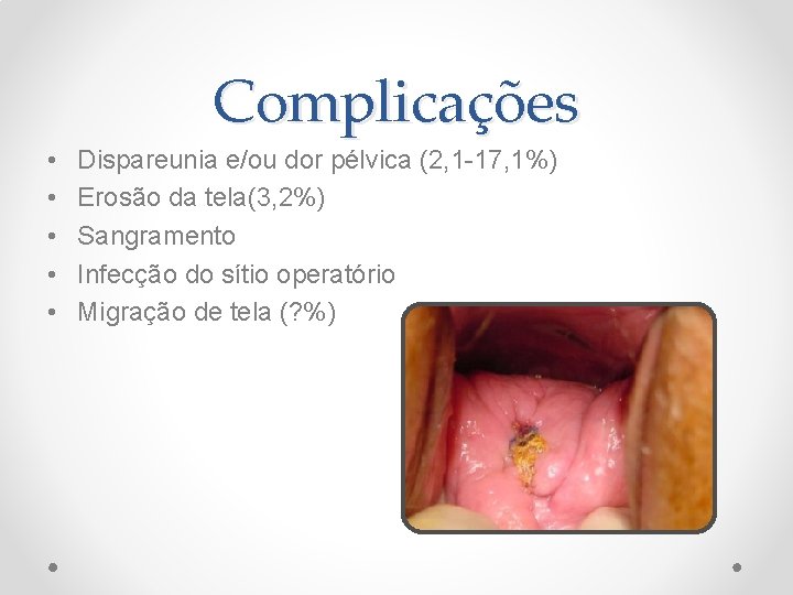 Complicações • • • Dispareunia e/ou dor pélvica (2, 1 -17, 1%) Erosão da Complicações • • • Dispareunia e/ou dor pélvica (2, 1 -17, 1%) Erosão da