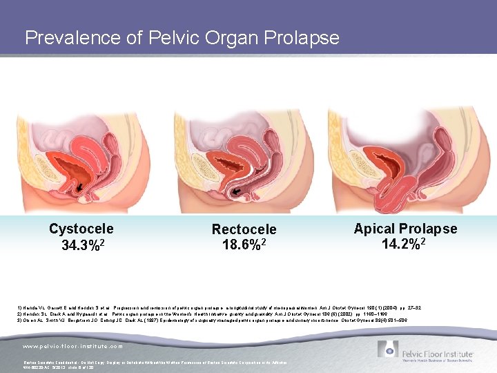 Prevalence of Pelvic Organ Prolapse Cystocele 34. 3%2 Rectocele 18. 6%2 Apical Prolapse 14. Prevalence of Pelvic Organ Prolapse Cystocele 34. 3%2 Rectocele 18. 6%2 Apical Prolapse 14.