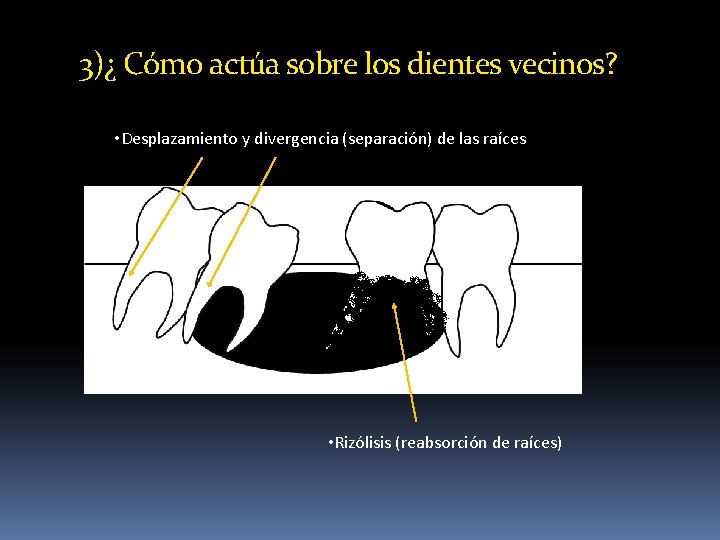 3)¿ Cómo actúa sobre los dientes vecinos? • Desplazamiento y divergencia (separación) de las 3)¿ Cómo actúa sobre los dientes vecinos? • Desplazamiento y divergencia (separación) de las