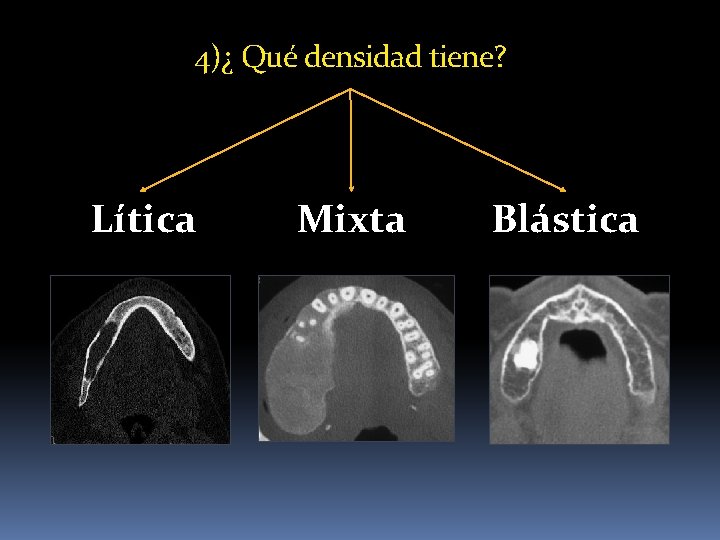 4)¿ Qué densidad tiene? Lítica Mixta Blástica 4)¿ Qué densidad tiene? Lítica Mixta Blástica