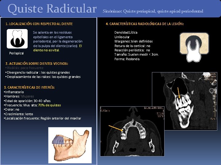 Quiste Radicular 1. LOCALIZACIÓN CON RESPECTO AL DIENTE Periapical Se asienta en los residuos Quiste Radicular 1. LOCALIZACIÓN CON RESPECTO AL DIENTE Periapical Se asienta en los residuos