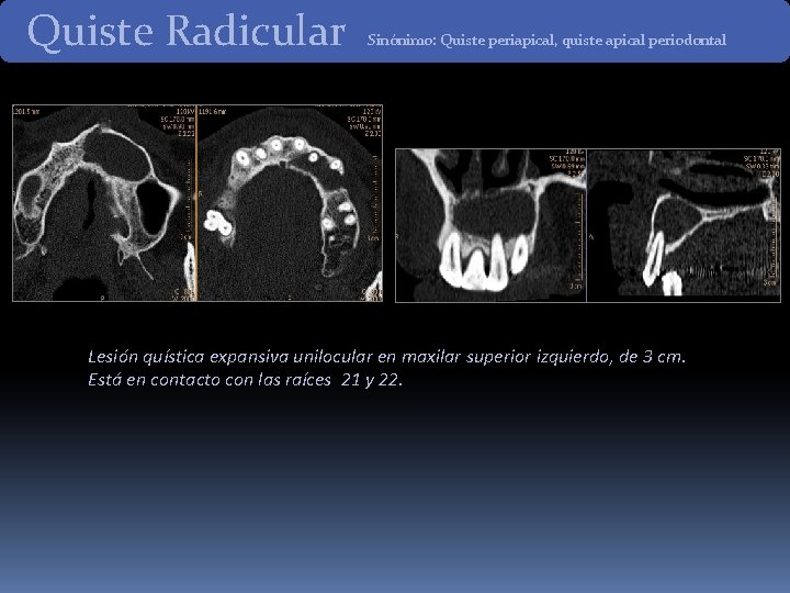 Quiste Radicular Sinónimo: Quiste periapical, quiste apical periodontal Lesión quística expansiva unilocular en maxilar Quiste Radicular Sinónimo: Quiste periapical, quiste apical periodontal Lesión quística expansiva unilocular en maxilar