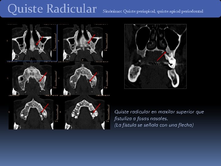 Quiste Radicular Sinónimo: Quiste periapical, quiste apical periodontal Quiste radicular en maxilar superior que Quiste Radicular Sinónimo: Quiste periapical, quiste apical periodontal Quiste radicular en maxilar superior que