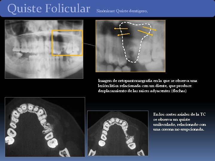 Quiste Folicular Sinónimo: Quiste dentígero, Imagen de ortopantomografía en la que se observa una Quiste Folicular Sinónimo: Quiste dentígero, Imagen de ortopantomografía en la que se observa una