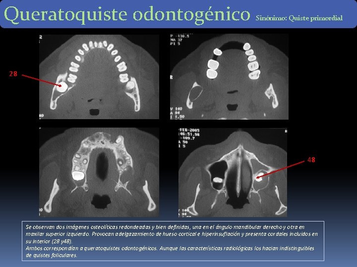Queratoquiste odontogénico Sinónimo: Quiste primordial 28 48 Se observan dos imágenes osteolíticas redondeadas y Queratoquiste odontogénico Sinónimo: Quiste primordial 28 48 Se observan dos imágenes osteolíticas redondeadas y