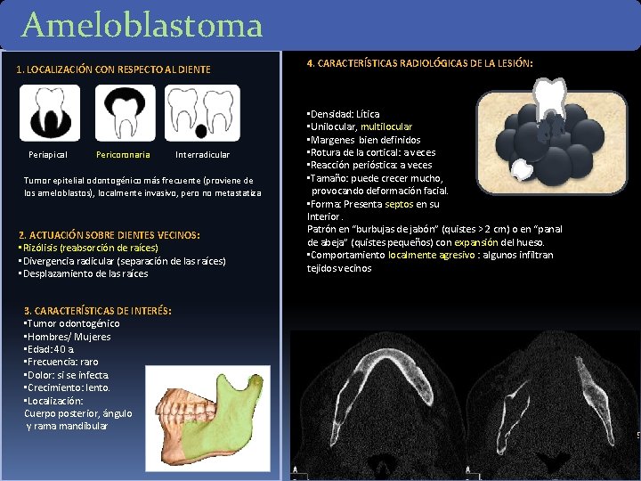 Ameloblastoma 1. LOCALIZACIÓN CON RESPECTO AL DIENTE Periapical Pericoronaria Interradicular Tumor epitelial odontogénico más Ameloblastoma 1. LOCALIZACIÓN CON RESPECTO AL DIENTE Periapical Pericoronaria Interradicular Tumor epitelial odontogénico más