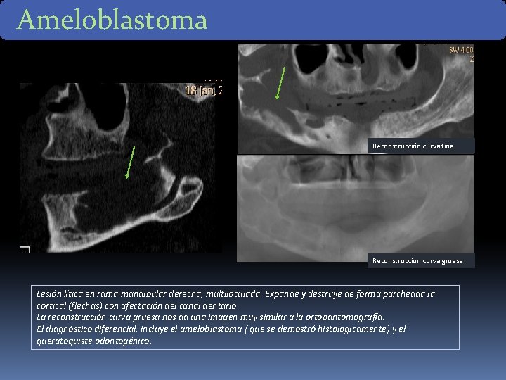 Ameloblastoma Reconstrucción curva fina Reconstrucción curva gruesa Lesión lítica en rama mandibular derecha, multiloculada. Ameloblastoma Reconstrucción curva fina Reconstrucción curva gruesa Lesión lítica en rama mandibular derecha, multiloculada.