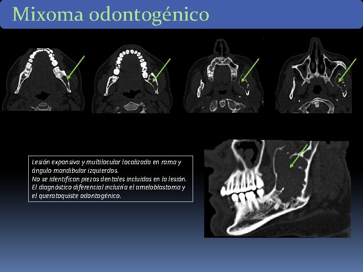 Mixoma odontogénico Lesión expansiva y multilocular localizada en rama y ángulo mandibular izquierdos. No Mixoma odontogénico Lesión expansiva y multilocular localizada en rama y ángulo mandibular izquierdos. No