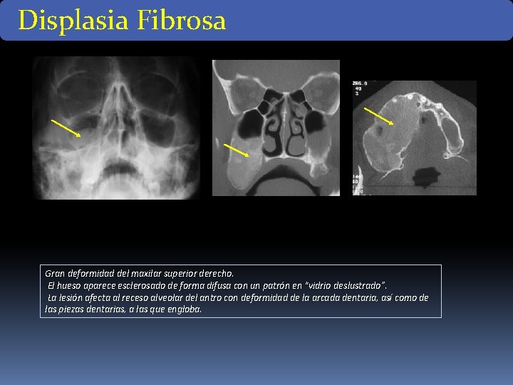 Displasia Fibrosa Gran deformidad del maxilar superior derecho. El hueso aparece esclerosado de forma Displasia Fibrosa Gran deformidad del maxilar superior derecho. El hueso aparece esclerosado de forma