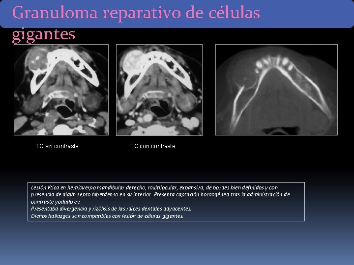 Granuloma reparativo de células gigantes TC sin contraste TC contraste Lesión lítica en hemicuerpo Granuloma reparativo de células gigantes TC sin contraste TC contraste Lesión lítica en hemicuerpo