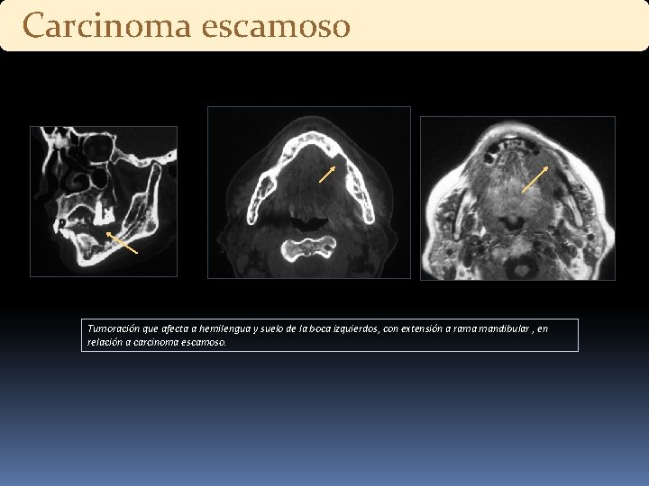 Carcinoma escamoso Tumoración que afecta a hemilengua y suelo de la boca izquierdos, con Carcinoma escamoso Tumoración que afecta a hemilengua y suelo de la boca izquierdos, con