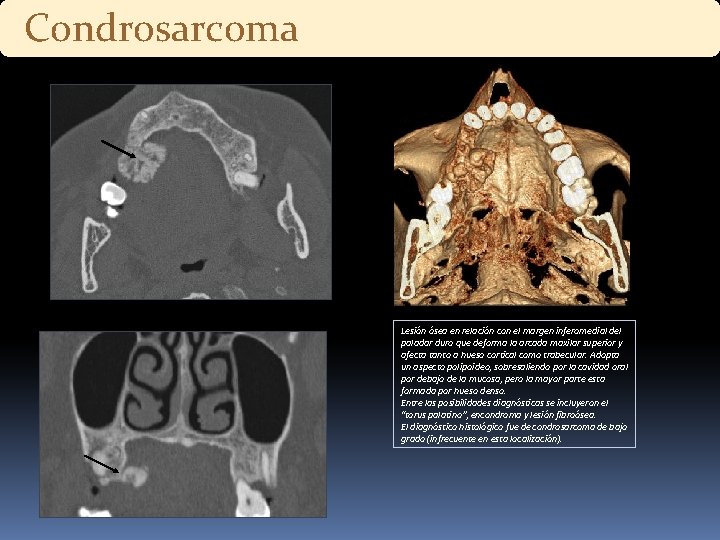 Condrosarcoma Lesión ósea en relación con el margen inferomedial del paladar duro que deforma Condrosarcoma Lesión ósea en relación con el margen inferomedial del paladar duro que deforma