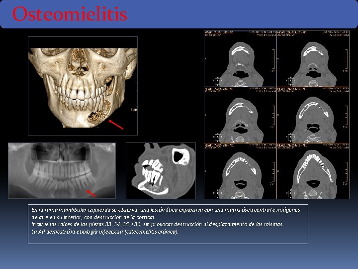 Osteomielitis En la rama mandibular izquierda se observa una lesión lítica expansiva con una Osteomielitis En la rama mandibular izquierda se observa una lesión lítica expansiva con una