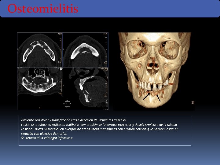 Osteomielitis Paciente con dolor y tumefacción tras extraccion de implantes dentales. Lesión osteolítica en Osteomielitis Paciente con dolor y tumefacción tras extraccion de implantes dentales. Lesión osteolítica en