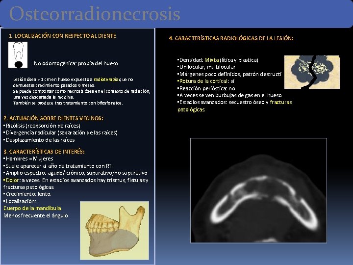 Osteorradionecrosis 1. LOCALIZACIÓN CON RESPECTO AL DIENTE No odontogénica: propia del hueso Lesión ósea Osteorradionecrosis 1. LOCALIZACIÓN CON RESPECTO AL DIENTE No odontogénica: propia del hueso Lesión ósea