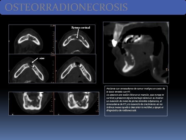 OSTEORRADIONECROSIS Rotura cortical aire Paciente con antecedente de tumor maligno en suelo de la OSTEORRADIONECROSIS Rotura cortical aire Paciente con antecedente de tumor maligno en suelo de la