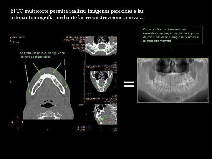 El TC multicorte permite realizar imágenes parecidas a las ortopantomografía mediante las reconstrucciones curvas… El TC multicorte permite realizar imágenes parecidas a las ortopantomografía mediante las reconstrucciones curvas…