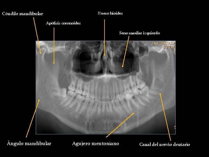 Cóndilo mandibular Hueso hioides Apófisis coronoides Seno maxilar izquierdo Ángulo mandibular Agujero mentoniano Canal Cóndilo mandibular Hueso hioides Apófisis coronoides Seno maxilar izquierdo Ángulo mandibular Agujero mentoniano Canal