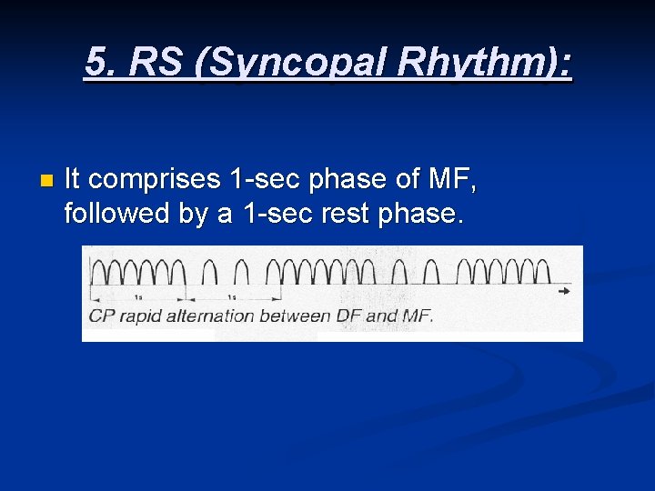 5. RS (Syncopal Rhythm): n It comprises 1 -sec phase of MF, followed by