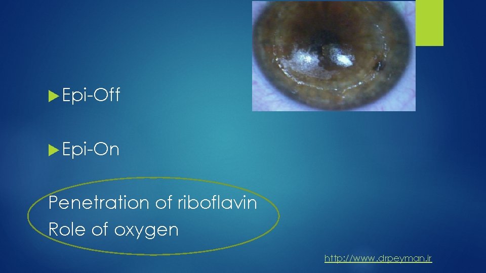  Epi-Off Epi-On Penetration of riboflavin Role of oxygen http: //www. drpeyman. ir 