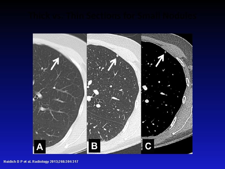 Thick vs. Thin Sections for Small Nodules Naidich D P et al. Radiology 2013;