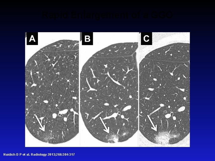 Rapid Enlargement of a GGO Naidich D P et al. Radiology 2013; 266: 304