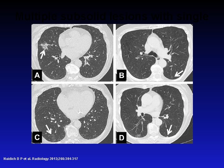 Multiple subsolid lesions with single dominant focus. Naidich D P et al. Radiology 2013;